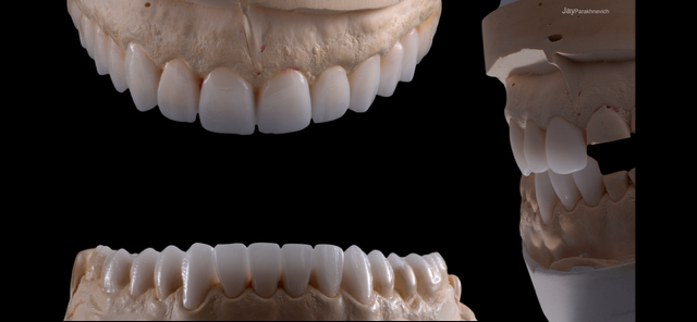 Diagnostic Wax-Up